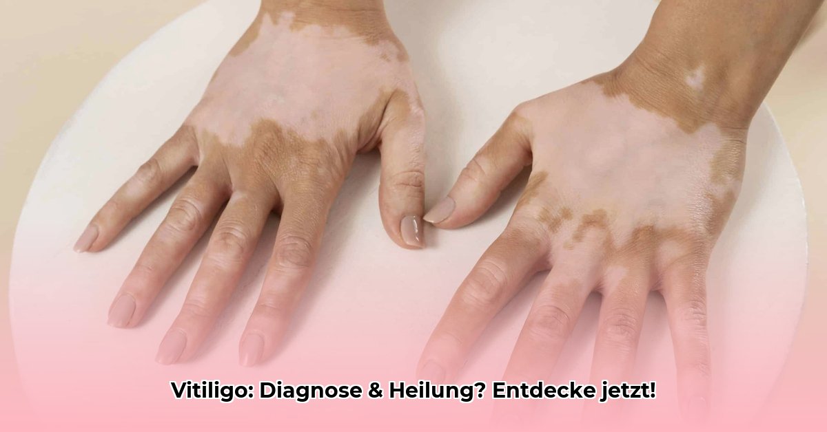 vitiligo